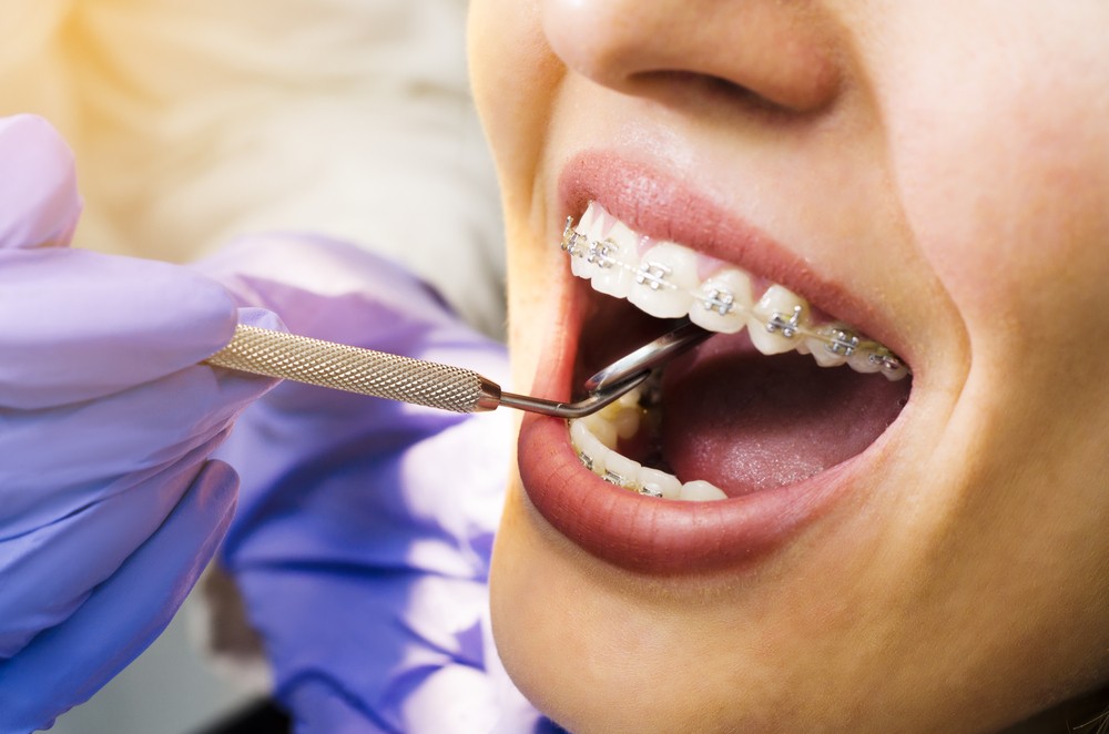aparat dentar bucuresti, ortodontie bucuresti, clinica stomatologica orto care bucuresti