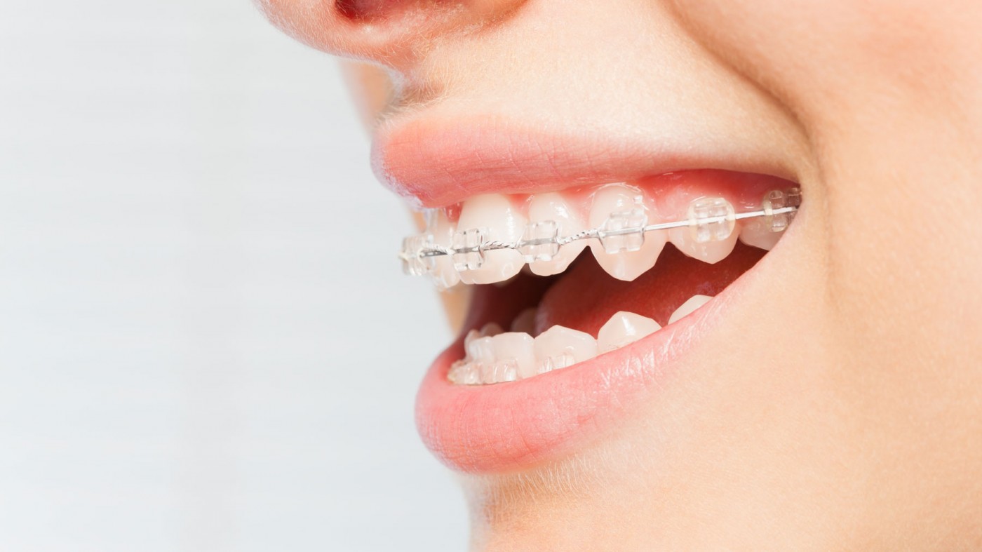 aparat dentar ceramic sector 3, aparat dentar ceramic sector 3 pret, aparat dentar ceramic bucuresti