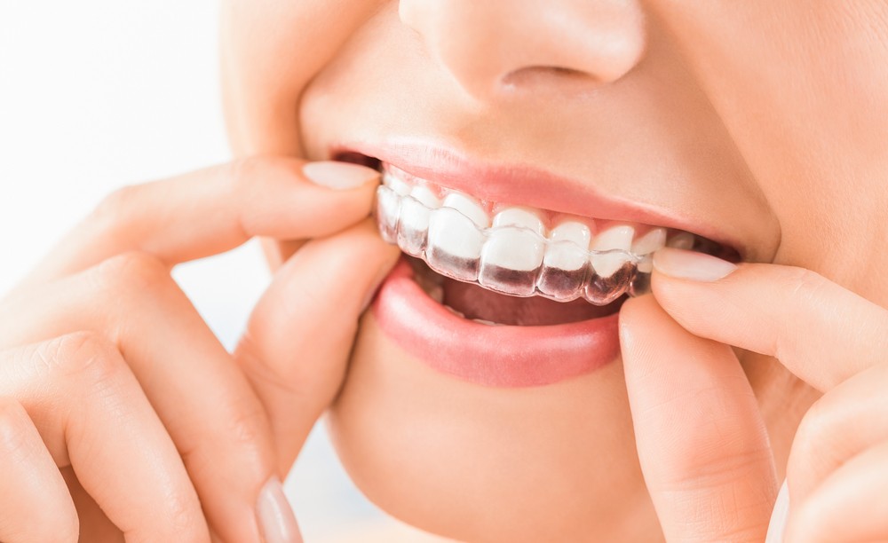 aparat dentar bucuresti, clinica stomatologica orto care bucuresti