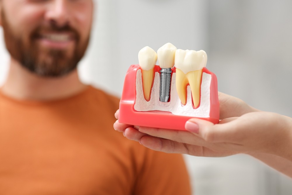 implant dentar
