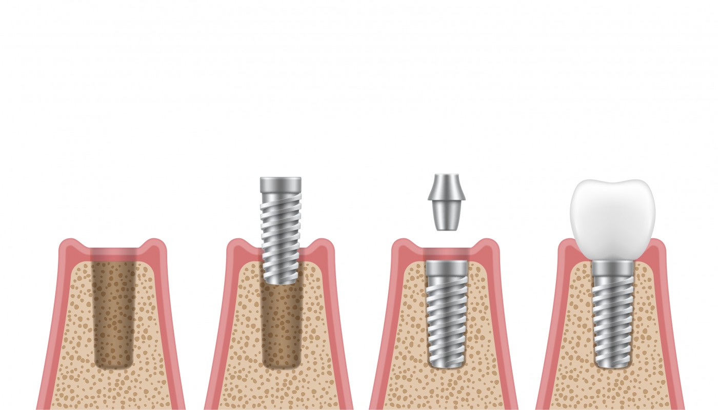 implant dentar