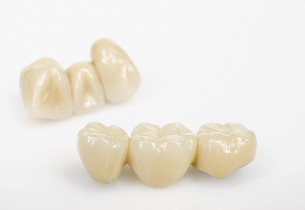 coroana dentara ceramica bucuresti, coroana dentara ceramica vitan, protetica dentara bucuresti