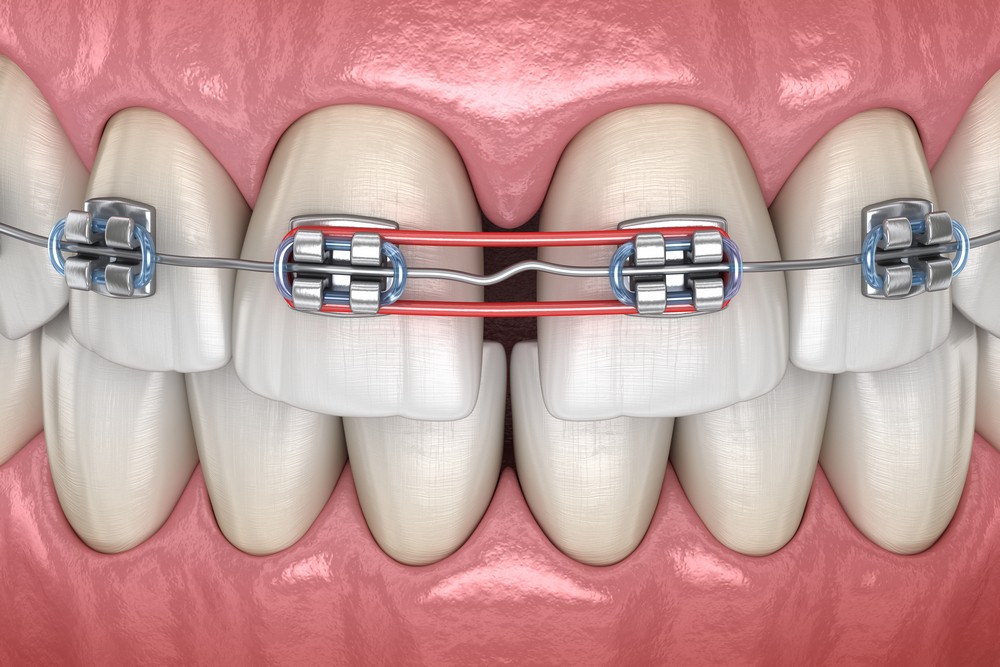 aparat dentar bucuresti, aparat lingual bucuresti, aparat metalic bucuresti, ortodontie bucuresti