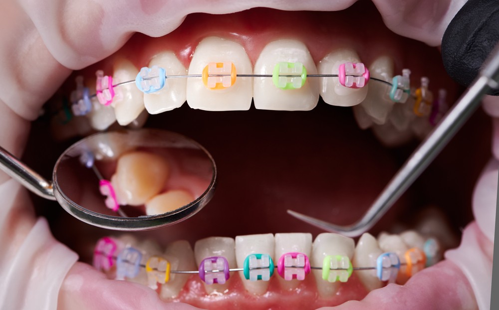 aparat dentar bucuresti