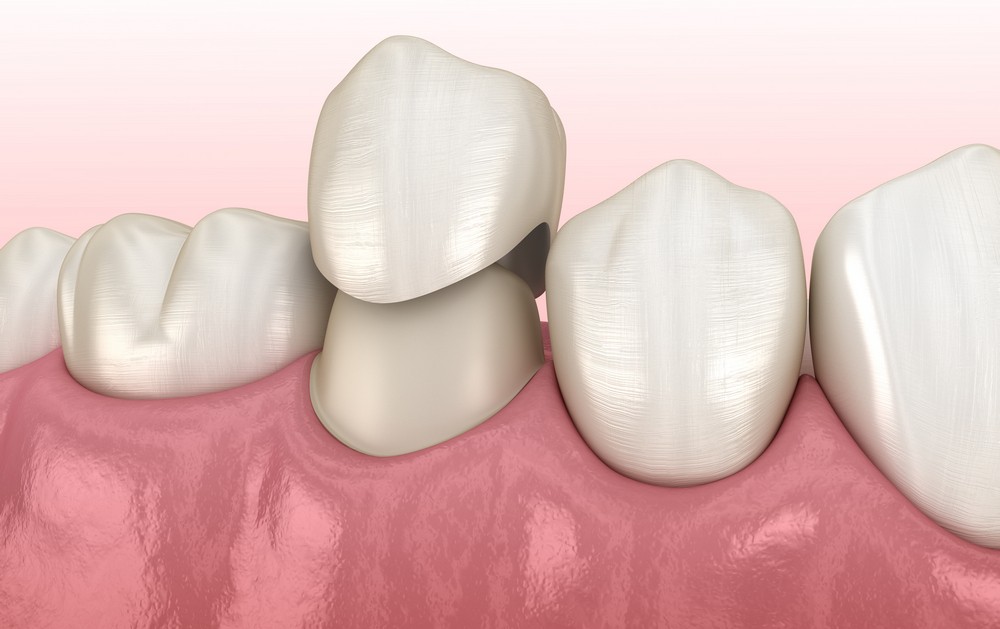 protetica dentara orto care, coroane dentare, coroane dentare bucresti, protetica dentara bucuresti,