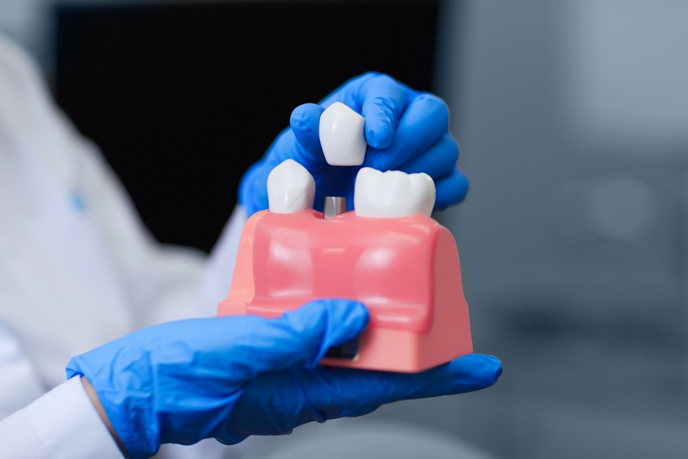Implant dentar