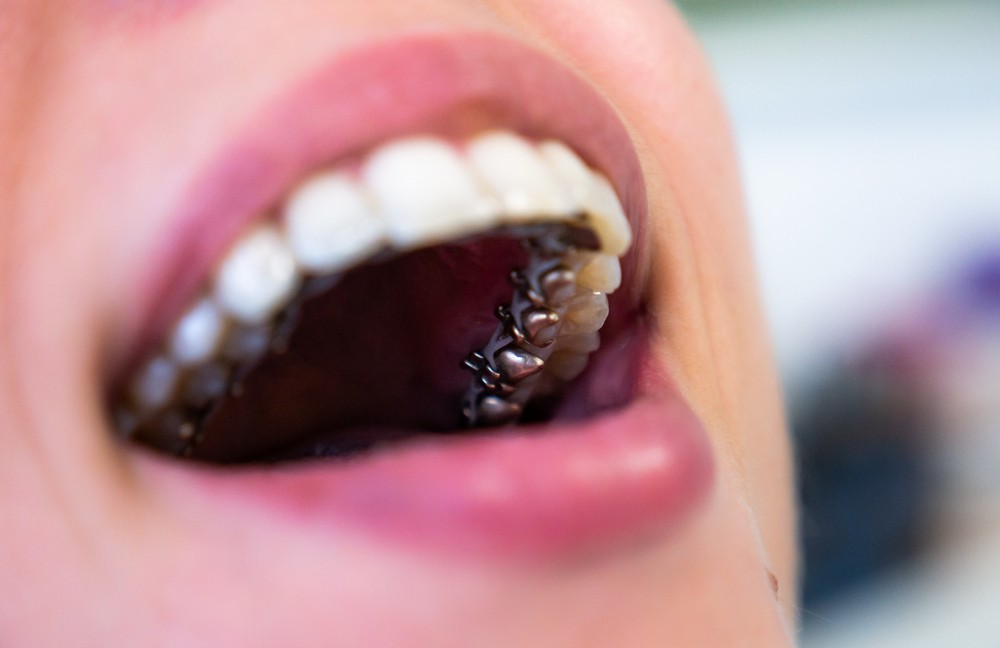 aparat dentar lingual bucuresti, aparat dentar bucuresti, aparat dentar metalic bucuresti