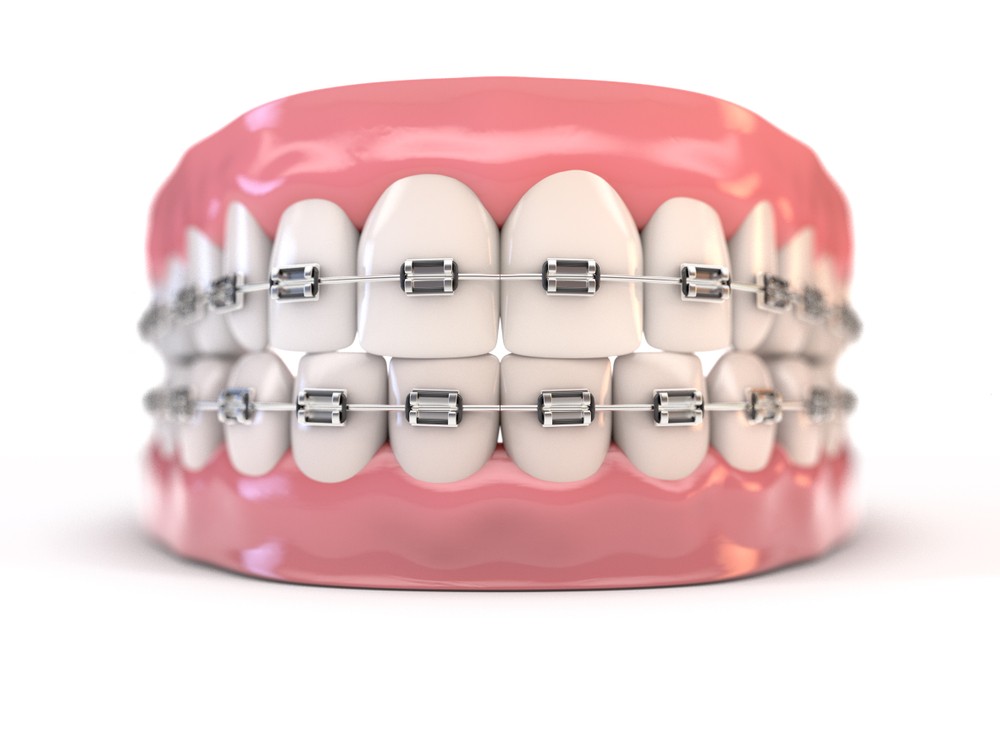 aparat dentar bucuresti
