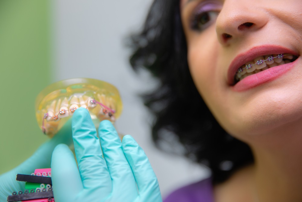 aparat dentar lingual bucuresti, aparat dentar bucuresti, aparat dentar metalic bucuresti